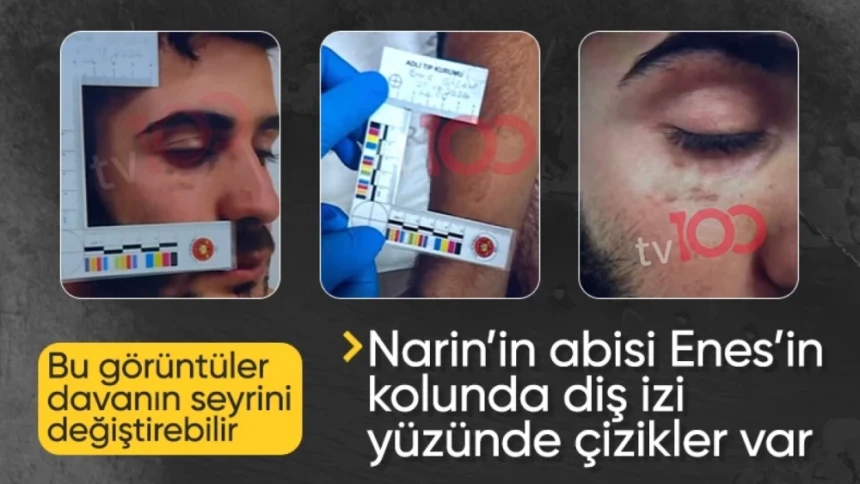 Narin davasının seyri değişecek: Enes Güran'ın kolunda diş, yüzünde çizikler var